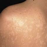 Photos of Dry Skin Patches Home Remedies