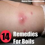 Photos of Boil Home Remedies