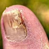 What Doctor Should I See For Toenail Fungus Images