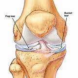 Photos of Home Remedies For Knee Ligament Tears
