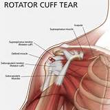 Rotator Cuff Muscle Strengthening