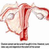 Images of Anovulation Home Remedies