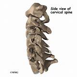 Pictures of Neck Vertebrae Out Of Alignment Treatment
