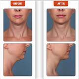 Images of Kybella Injections Side Effects