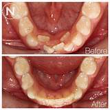 Orthodontic Treatment Photos Images