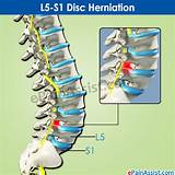 Pictures of Herniated Disk L5 S1 Treatment