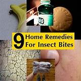Pictures of Home Remedies Bites