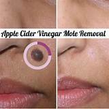 Pimples After Laser Hair Removal Treatment Images