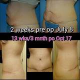 Pictures of Post Lipo Recovery