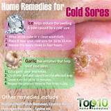 Pictures of Fast Home Remedies For Cold Sores