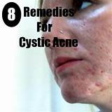 Photos of Best Home Treatment For Cystic Acne