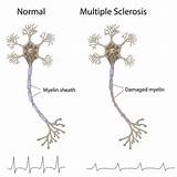 Photos of New Treatment For Primary Progressive Multiple Sclerosis