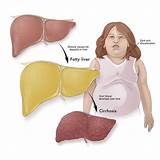 Fatty Liver Pain Medication Pictures