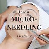 What Is Micro Needling Treatment Images