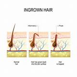 Images of Ingrown Hair Abscess Treatment