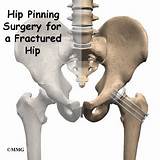 Hip Bone Surgery Recovery Time Pictures