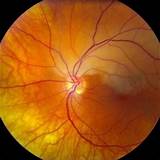 Photos of Branch Retinal Vein Occlusion Mayo Clinic
