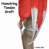 Pictures of Acl Hamstring Graft Recovery