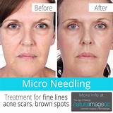 What Is Micro Needling Treatment Photos