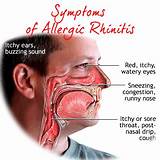 Sneezing Allergy Treatment In Ayurveda Pictures