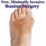 Images of Foot Surgery For Bunions Recovery