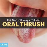 Images of Thrush Mouth Treatment Adults