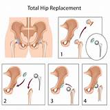 Images of Hip Bone Surgery Recovery Time