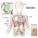 Pictures of Classical Hodgkin Lymphoma Treatment