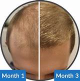 Photos of Hair Thinning Treatment Male