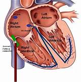 Images of Ep Study And Ablation Recovery Time