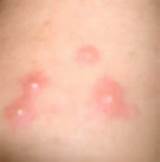 Images of After Bed Bug Treatment Bites