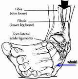 Ankle Ligament Surgery Brostrom Recovery Time Pictures