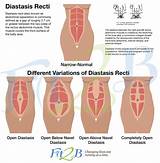 Photos of Diastasis Recti Rehabilitation