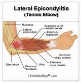 Physical Therapy For Tennis Elbow Tendonitis Images