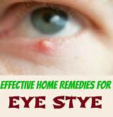 Pictures of An Eye Stye Home Remedies