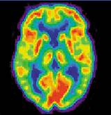 Inflammation Of The Brain Medical Term Pictures