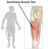 Pictures of Quadriceps Muscle Exercise