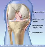 Posterior Cruciate Ligament Tear Treatment Pictures