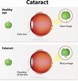 Pictures of Cataract Surgery Recovery What To Expect