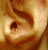 Images of Home Remedies Infant Ear Infection