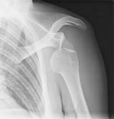 Complications Of Shoulder Surgery Treatment And Prevention Photos
