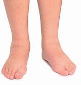 Which Doctor To Consult For Swelling In Feet Images