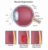 Vitamin Therapy For Macular Degeneration Pictures