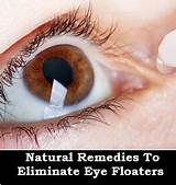 Causes Eye Floaters Mayo Clinic Pictures