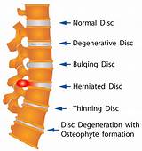 Chiropractic Treatment For Bulging Disc In Lower Back