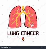 Lung Cancer Treatment Mexico Photos