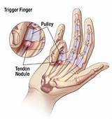 Images of Finger Physical Therapy