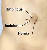 Emergency Hernia Surgery Recovery Images