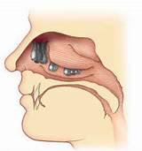 Medication For Nasal Polyps Pictures