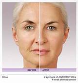 Where Can Juvederm Be Injected Photos